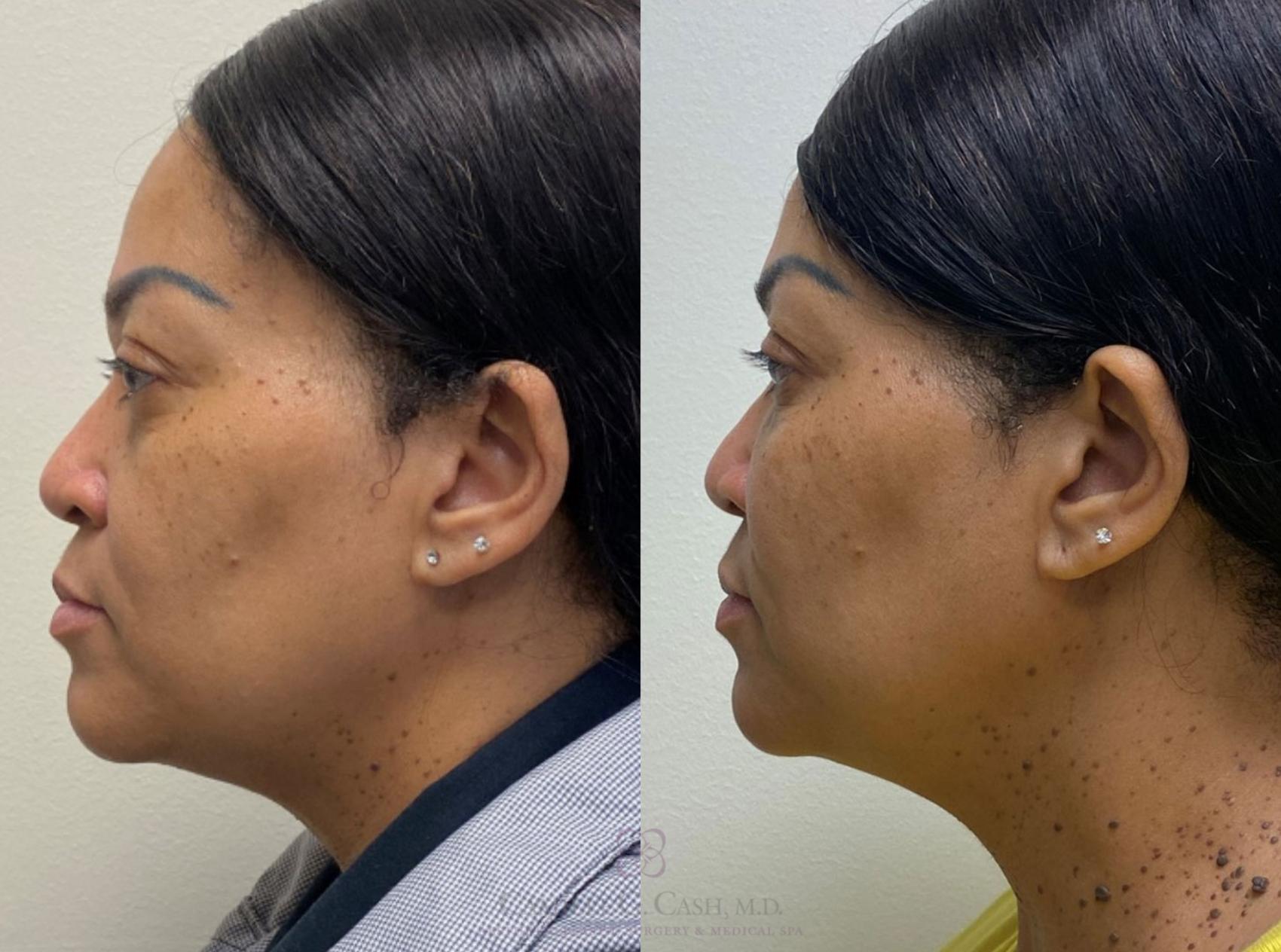 Before & After Dermal Fillers Case 381 View #4 View in Houston, TX