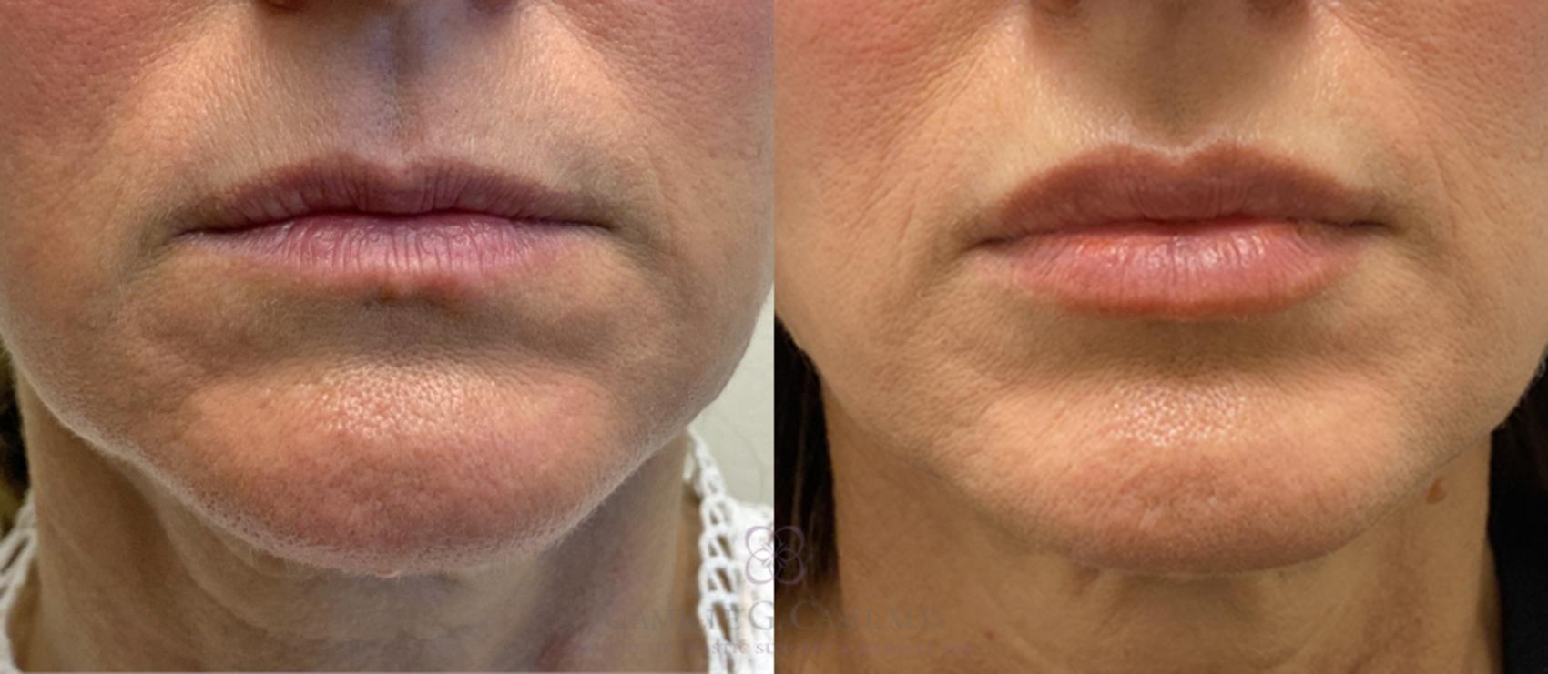 Before & After Dermal Fillers Case 382 View #1 View in Houston, TX