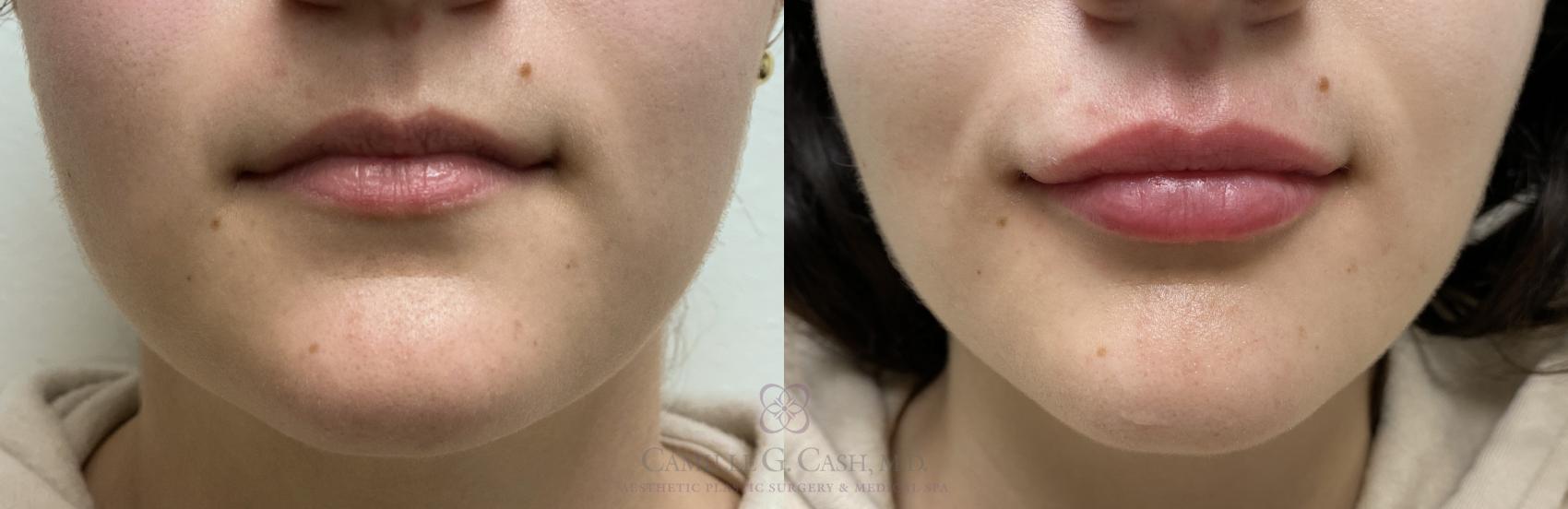 Before & After Dermal Fillers Case 411 View #1 View in Houston, TX