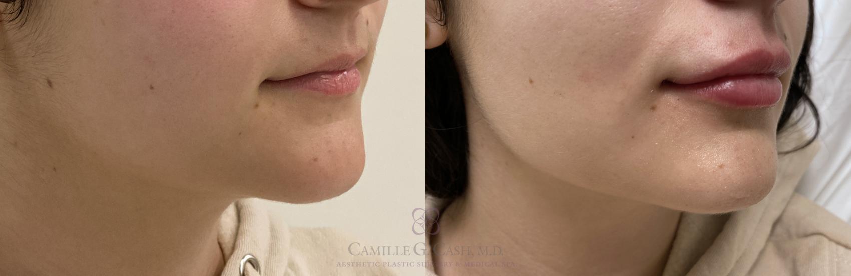 Before & After Dermal Fillers Case 411 View #2 View in Houston, TX
