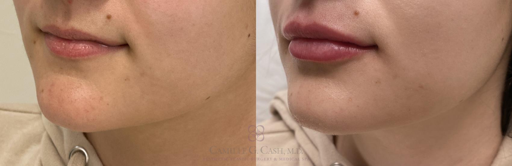Before & After Dermal Fillers Case 411 View #3 View in Houston, TX