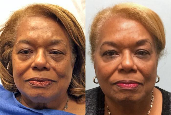 Before & After Dermal Fillers Case 428 View #1 View in Houston, TX