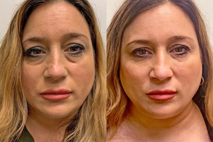Before & After Dermal Fillers Case 442 View #1 View in Houston, TX