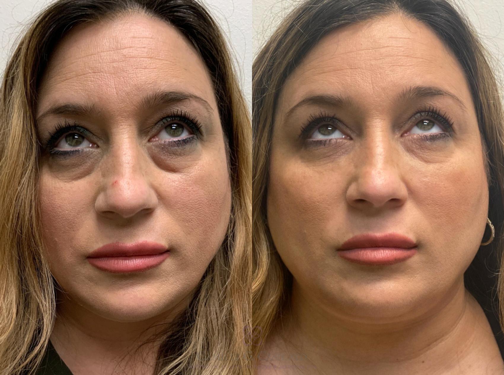 Before & After Dermal Fillers Case 442 View #2 View in Houston, TX