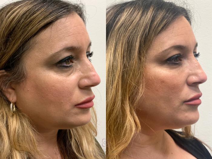 Before & After Dermal Fillers Case 442 View #3 View in Houston, TX