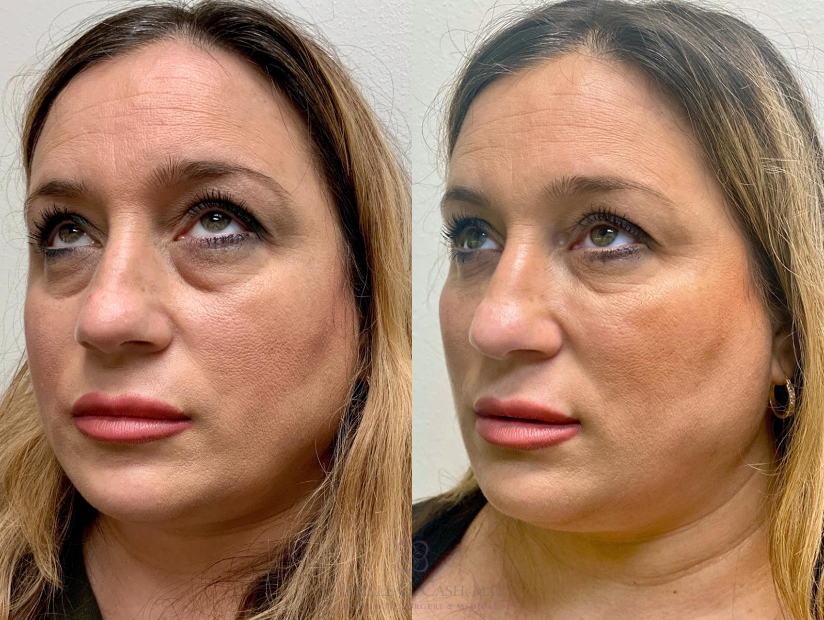 Before & After Dermal Fillers Case 442 View #4 View in Houston, TX