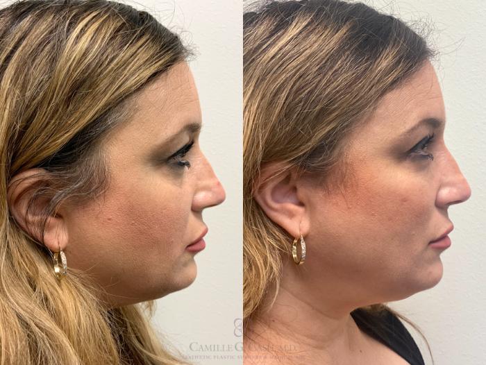 Before & After Dermal Fillers Case 442 View #5 View in Houston, TX