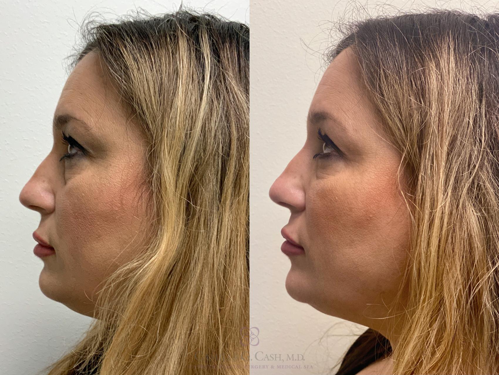 Before & After Dermal Fillers Case 442 View #6 View in Houston, TX