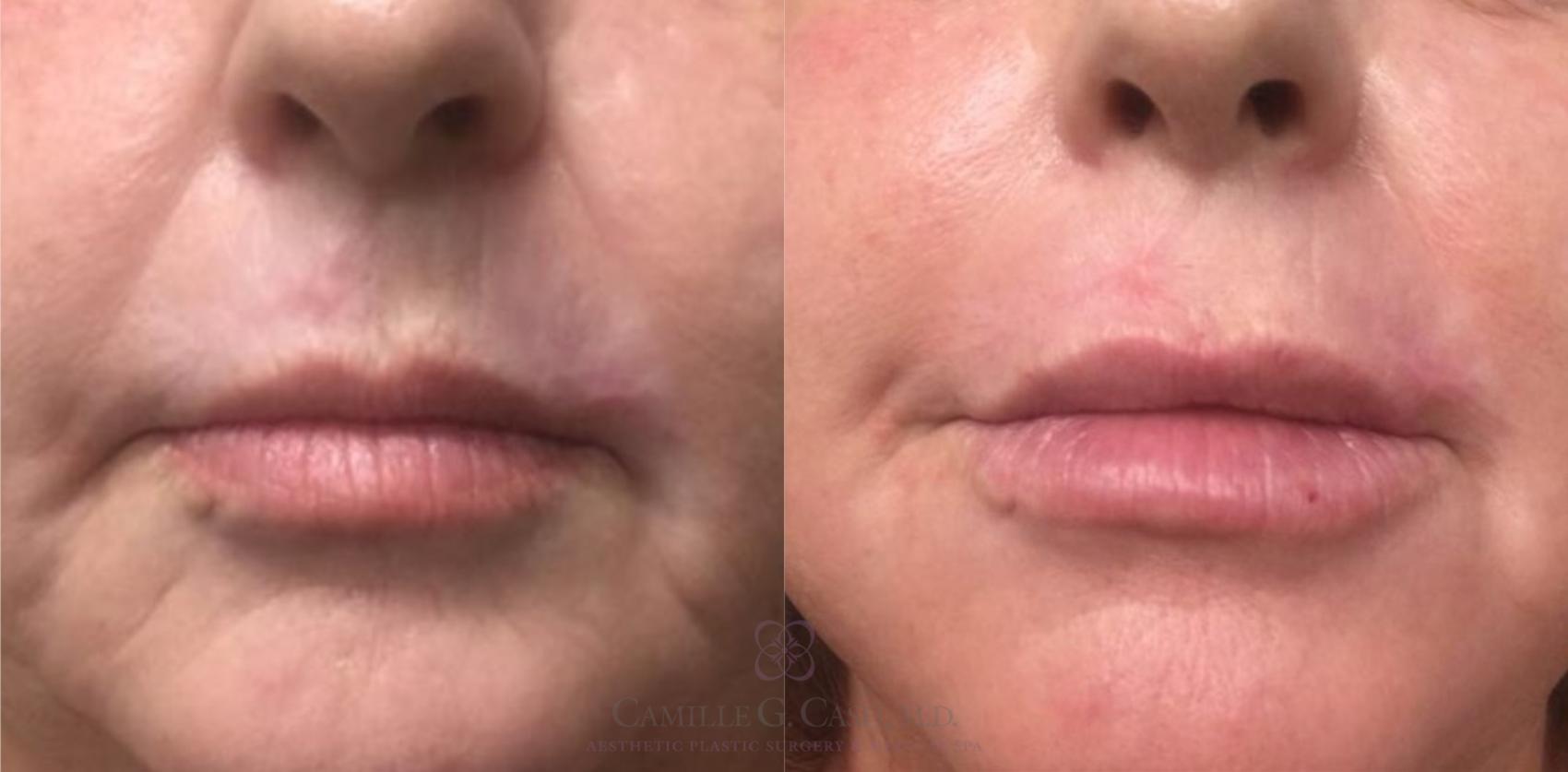 Before & After Dermal Fillers Case 462 Front View in Houston, TX