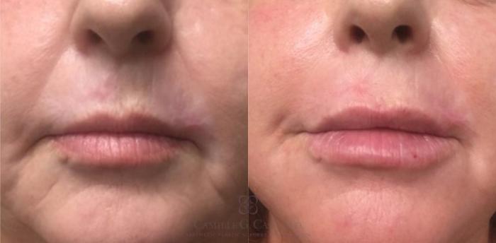 Before & After Lip Augmentation Case 462 Front View in Houston, TX