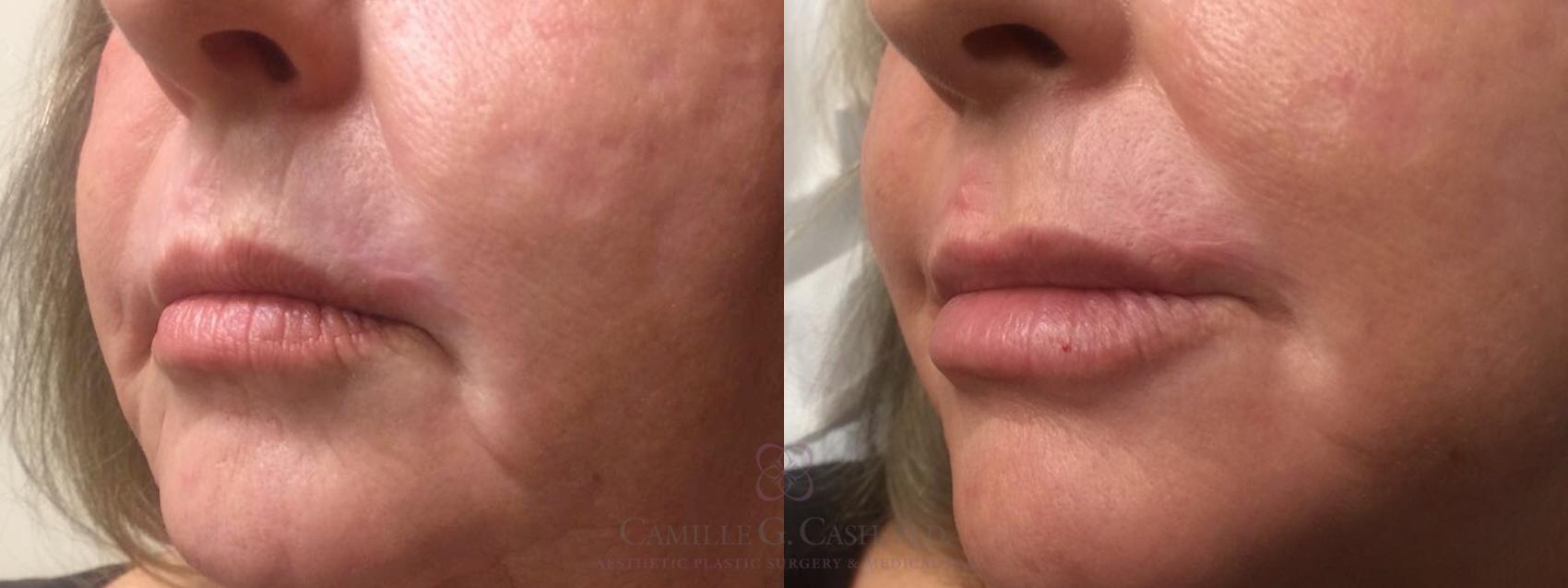 Before & After Lip Augmentation Case 462 Left Oblique View in Houston, TX