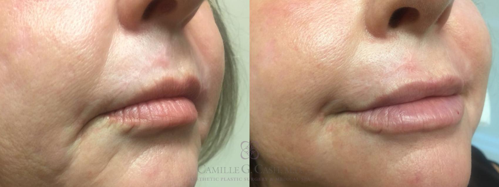 Before & After Dermal Fillers Case 462 Right Oblique View in Houston, TX