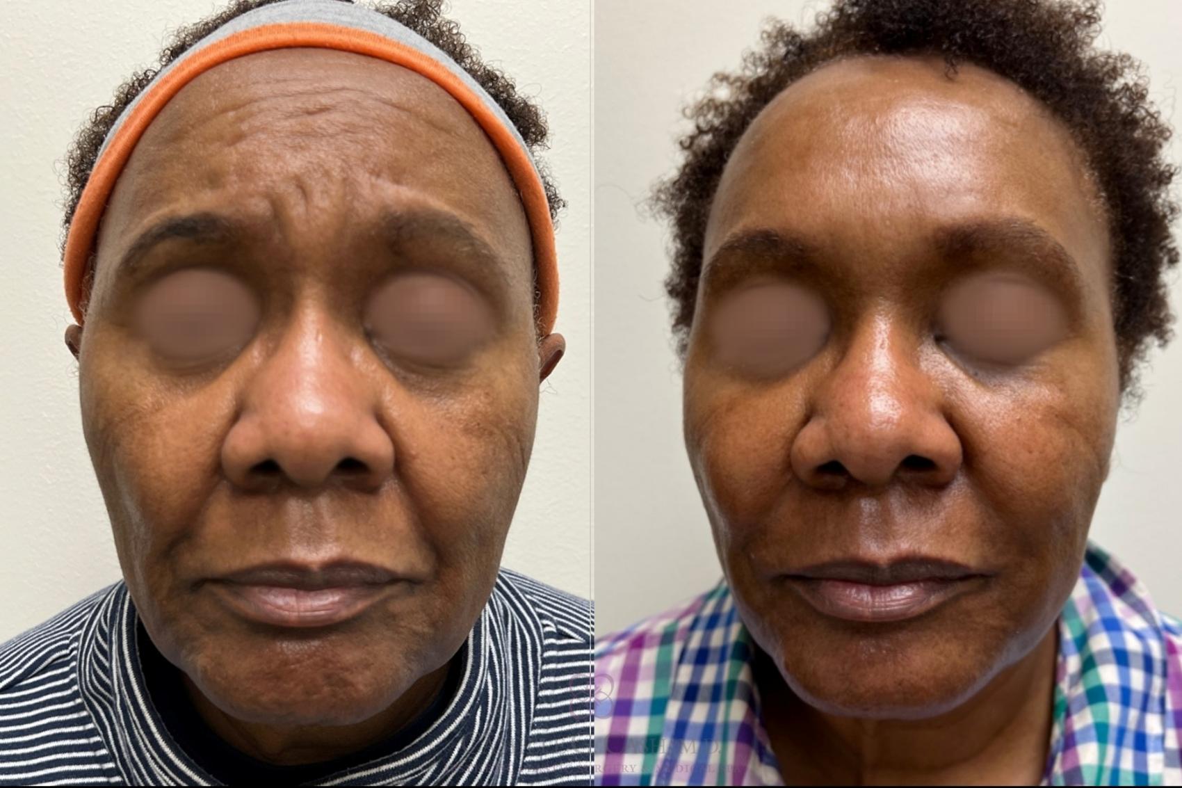 Before & After Dermal Fillers Case 482 Front View in Houston, TX