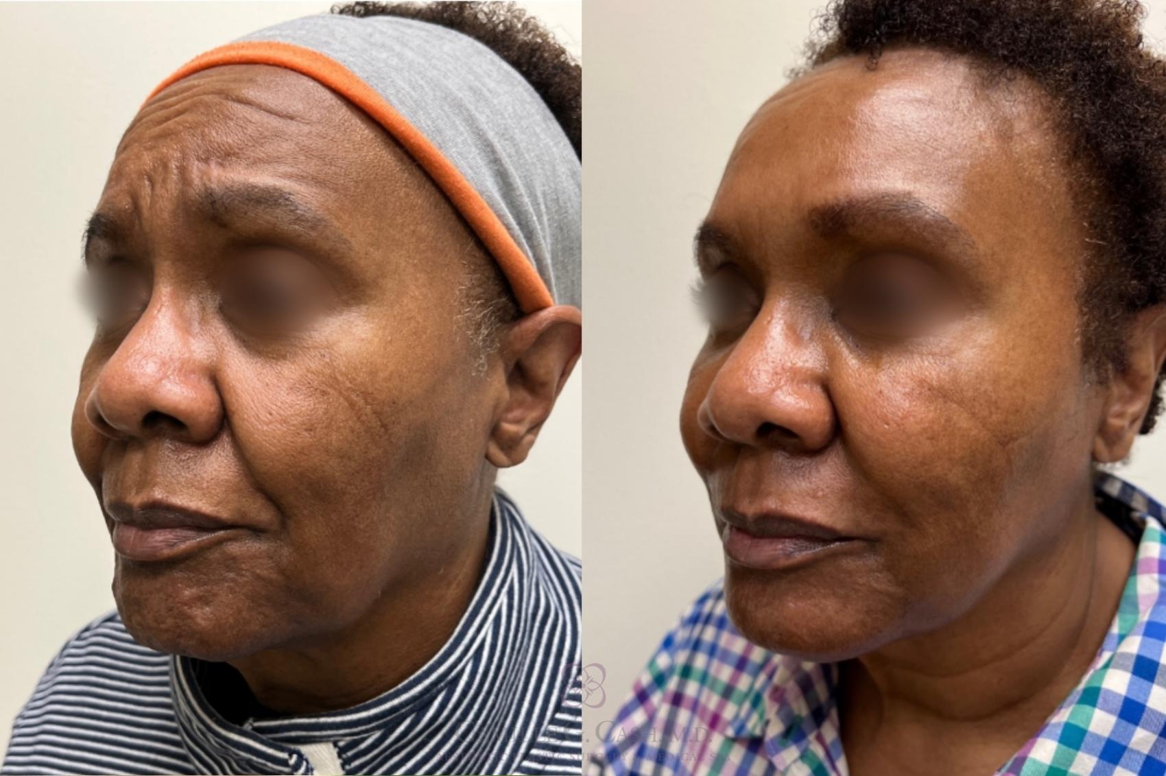 Before & After Dermal Fillers Case 482 ob 3 View in Houston, TX