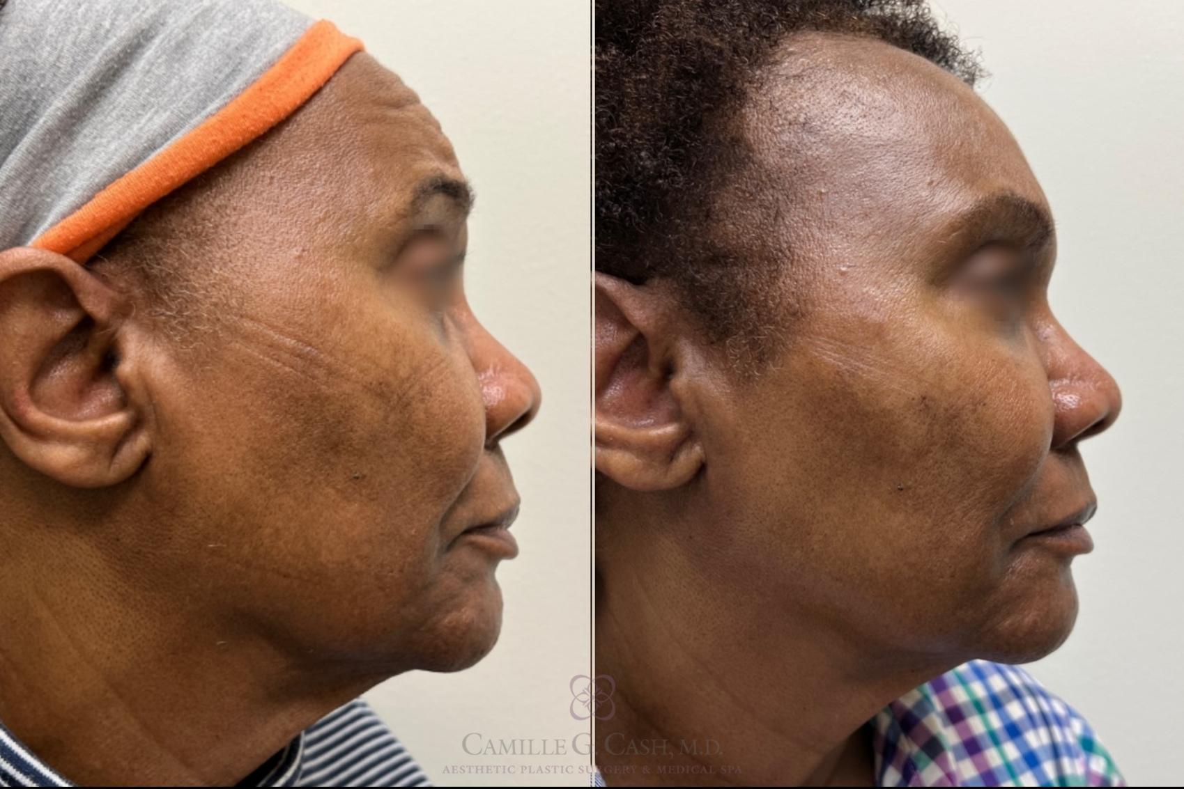 Before & After Dermal Fillers Case 482 side View in Houston, TX