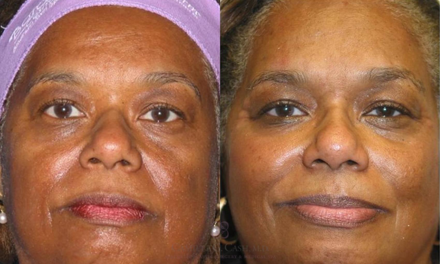 Before & After Dermal Fillers Case 58 View #1 View in Houston, TX