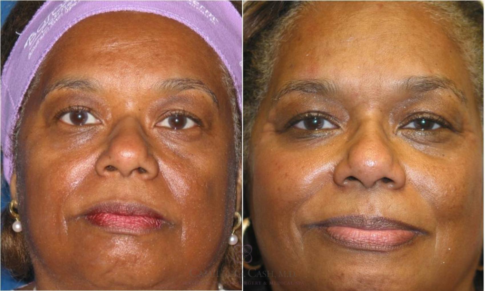 Before & After Dermal Fillers Case 58 View #2 View in Houston, TX