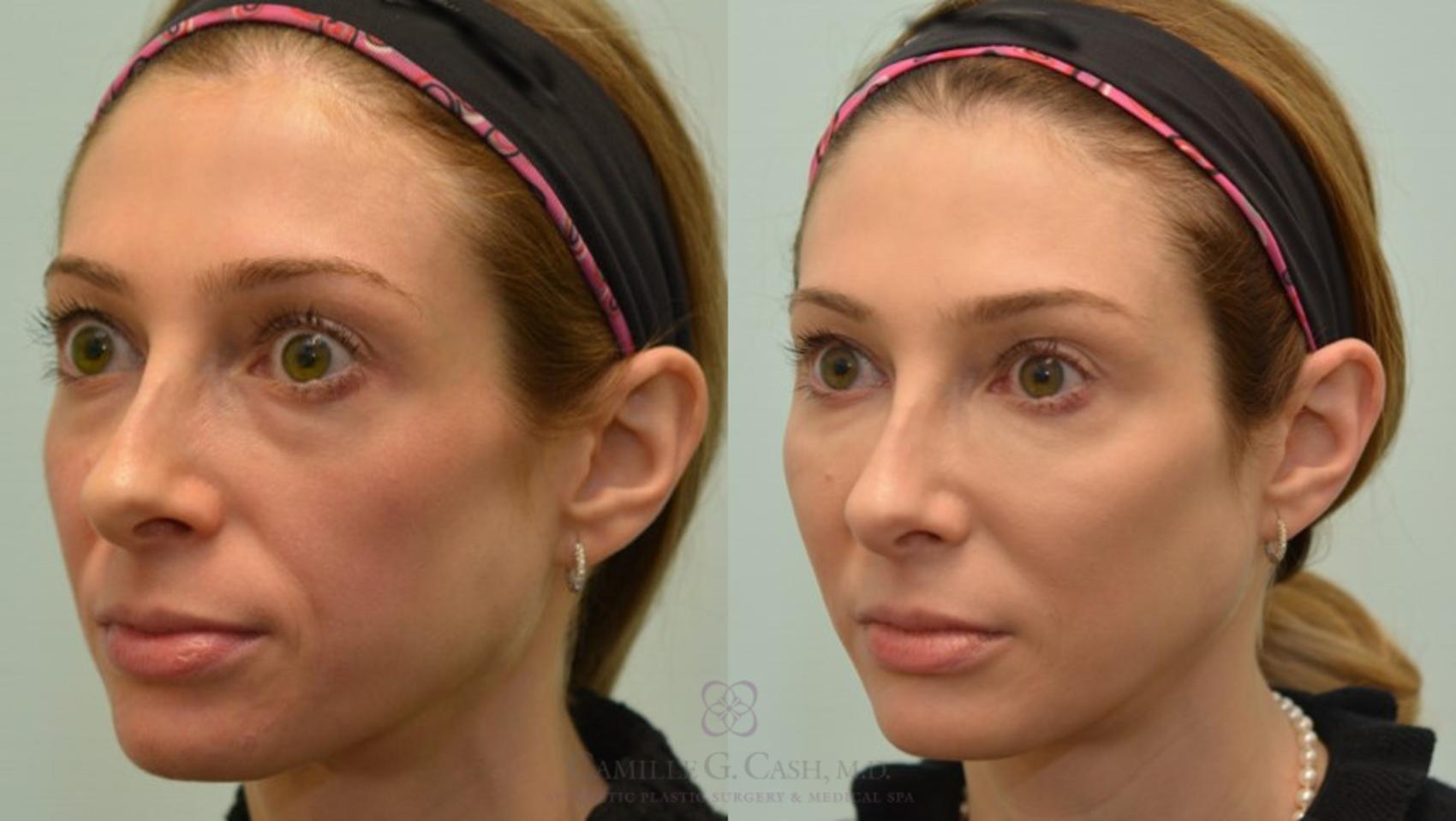 Before & After Dermal Fillers Case 60 View #4 View in Houston, TX