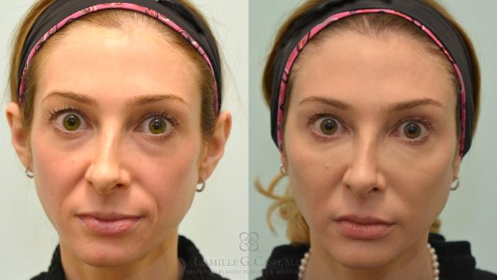 Before & After Dermal Fillers Case 60 View #5 View in Houston, TX
