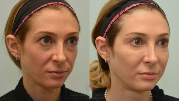 Before & After Dermal Fillers Case 60 View #7 View in Houston, TX