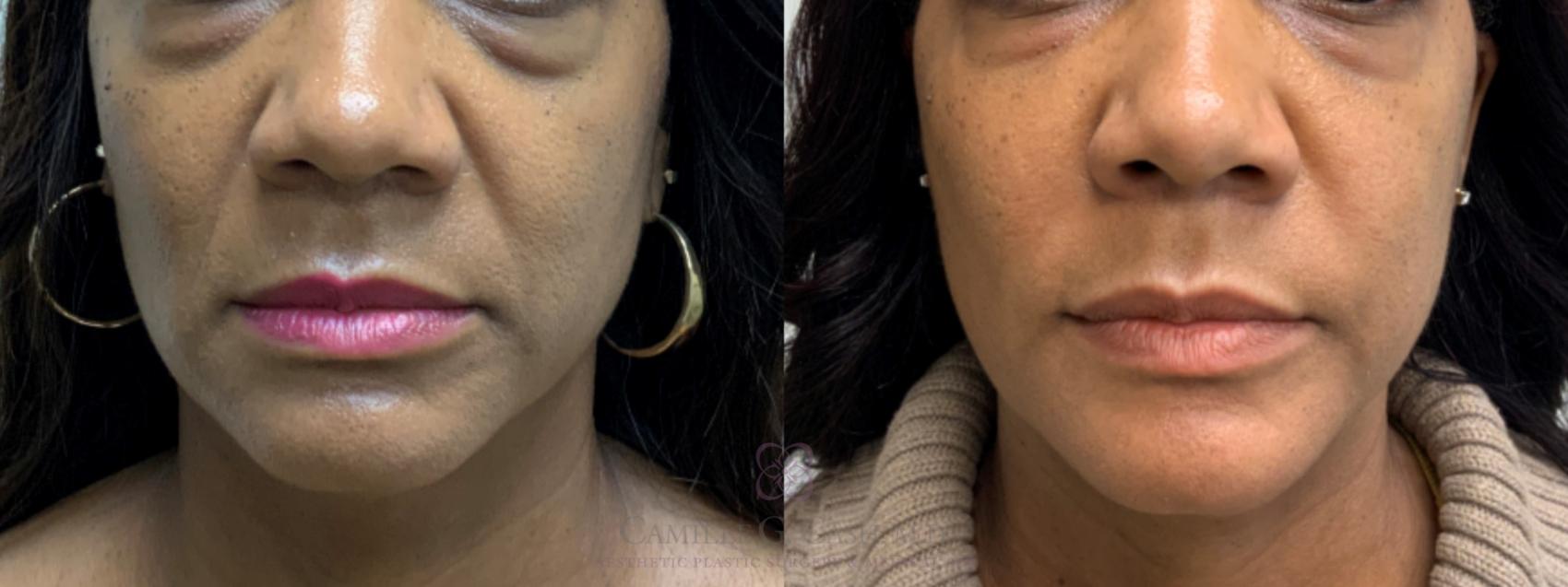 Before & After Dermal Fillers Case 631 Front View in Houston, TX