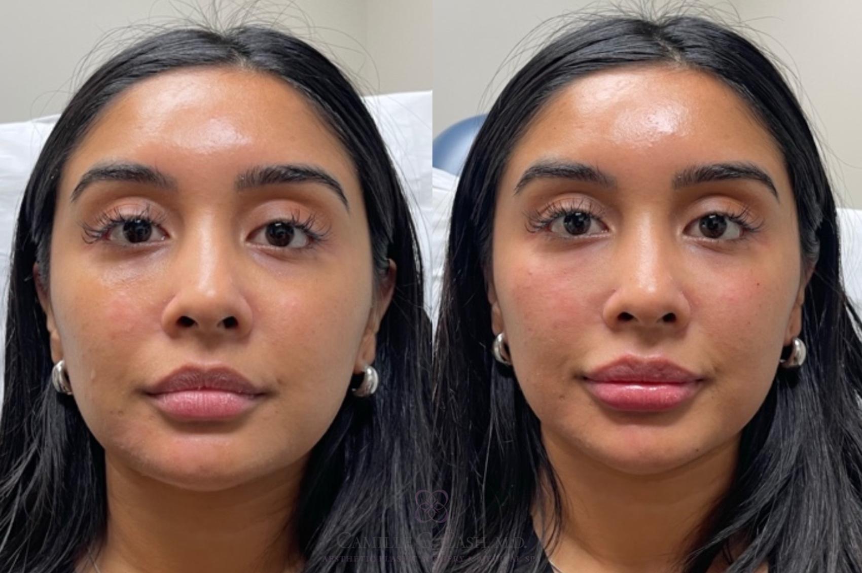Before & After Dermal Fillers Case 683 Front View in Houston, TX