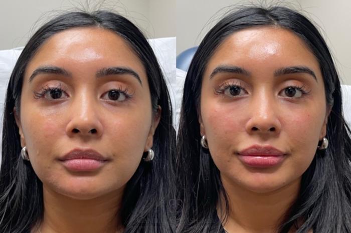 Before & After Dermal Fillers Case 683 Front View in Houston, TX