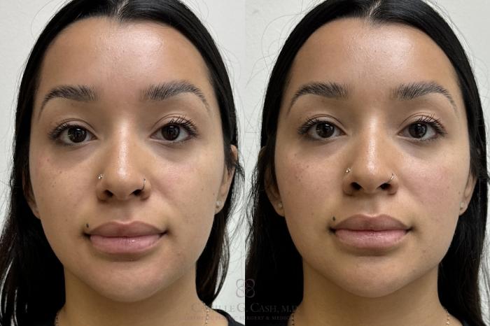 Before & After Dermal Fillers Case 708 Front View in Houston, TX