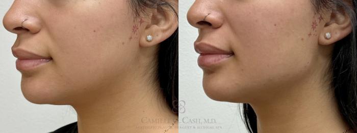 Before & After Dermal Fillers Case 708 left oblique close up View in Houston, TX