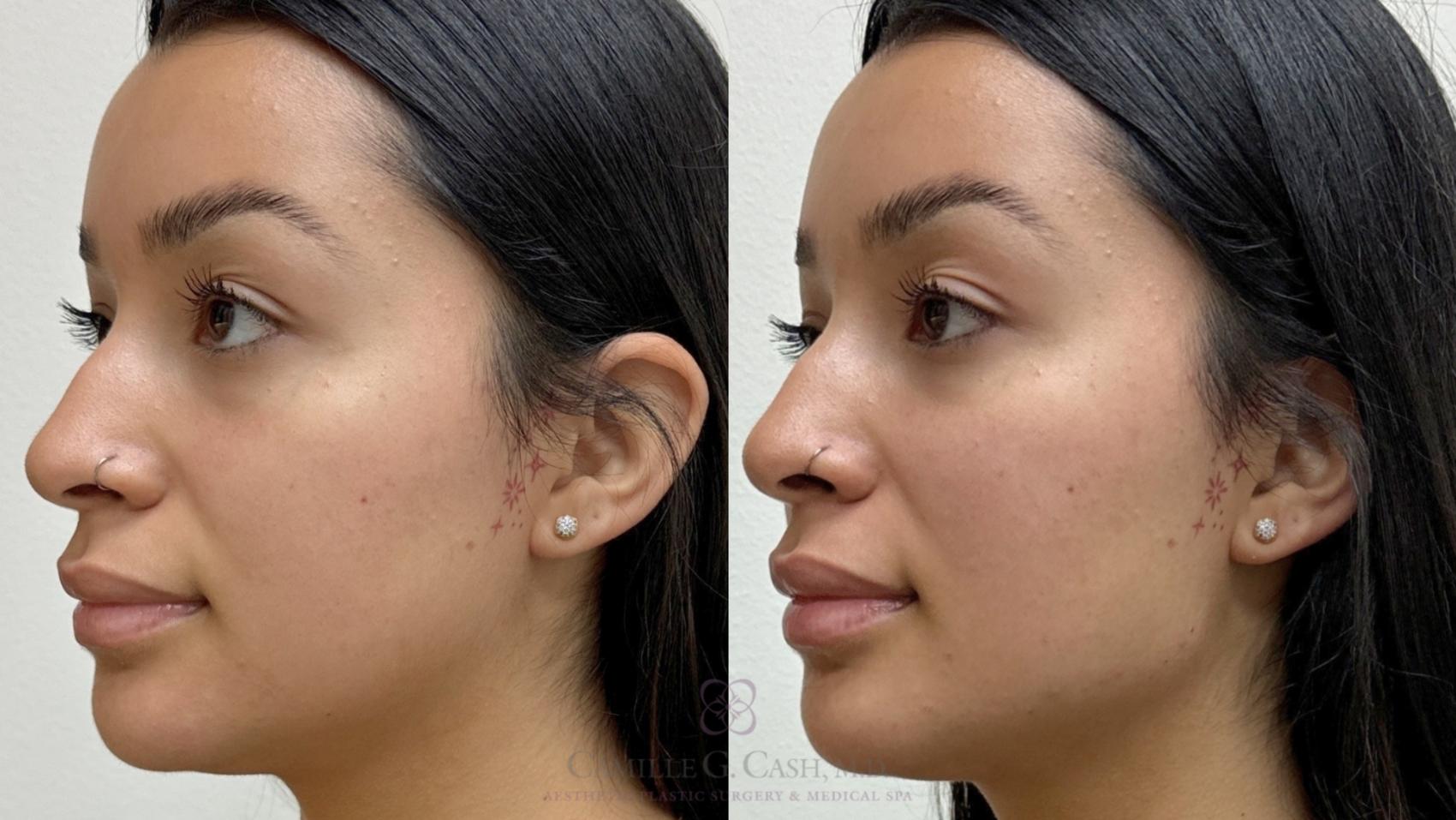 Fillers For Face Near Me