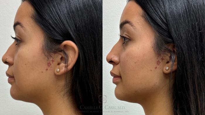 Before & After Dermal Fillers Case 708 Left Side View in Houston, TX