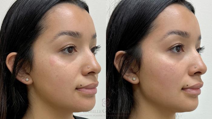 Before & After Dermal Fillers Case 708 Right Oblique View in Houston, TX