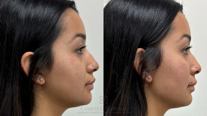 Before & After Dermal Fillers Case 708 Right Side View in Houston, TX