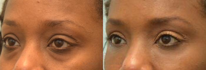 Before & After Dermal Fillers Case 76 View #1 View in Houston, TX