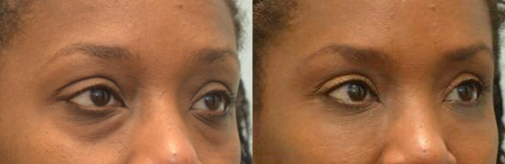 Before & After Dermal Fillers Case 76 View #2 View in Houston, TX