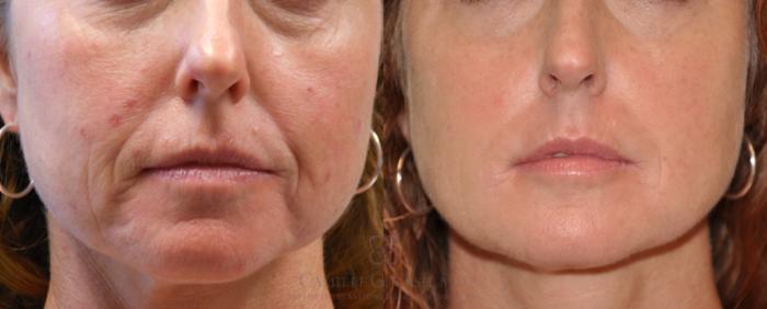 Before & After Dermal Fillers Case 83 View #2 View in Houston, TX