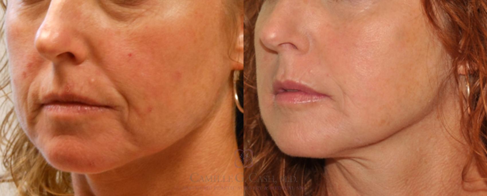 Before & After Dermal Fillers Case 83 View #3 View in Houston, TX