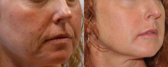 Before & After Dermal Fillers Case 83 View #4 View in Houston, TX