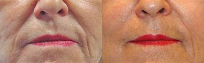 Before & After Dermal Fillers Case 88 View #1 View in Houston, TX