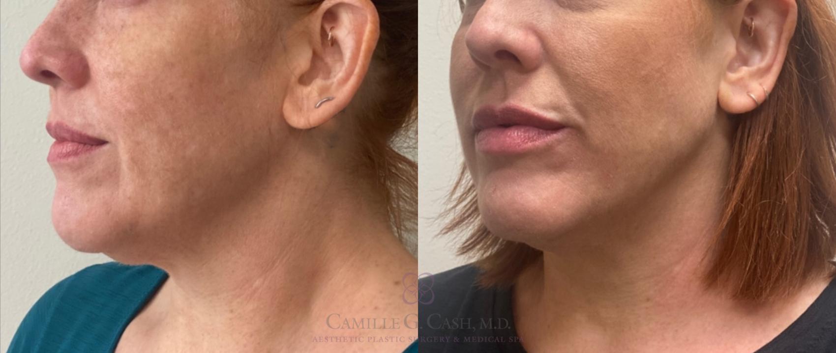 Before & After Evoke by InMode Case 465 Left Oblique View in Houston, TX