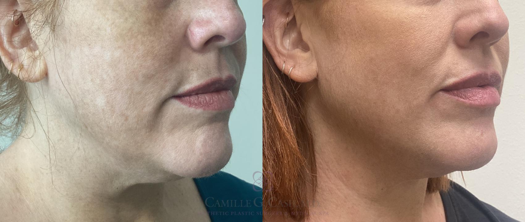 Before & After Evoke by InMode Case 465 Right Oblique View in Houston, TX