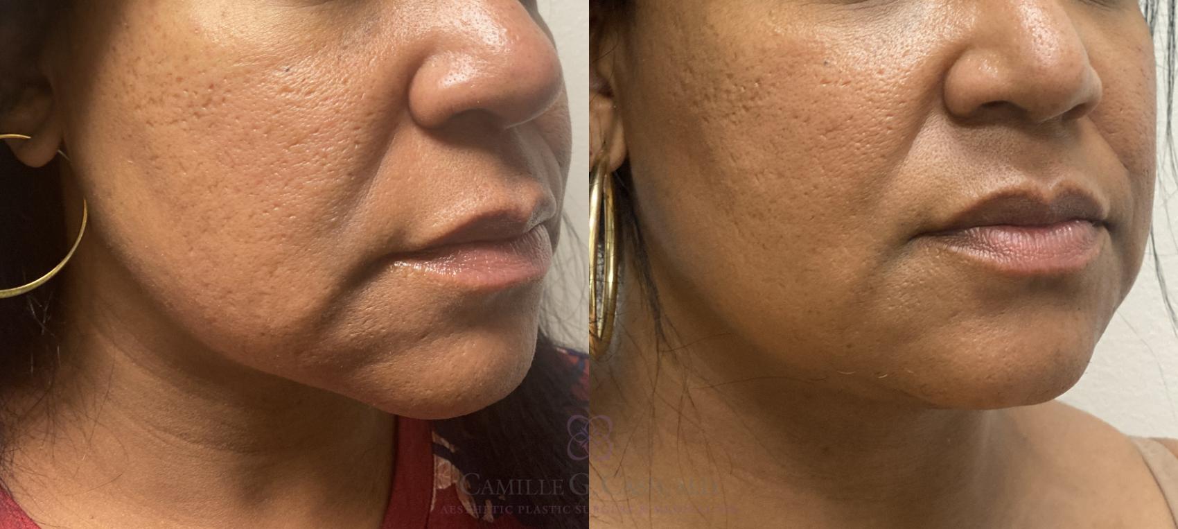 Before & After Evoke by InMode Case 466 Left Oblique View in Houston, TX
