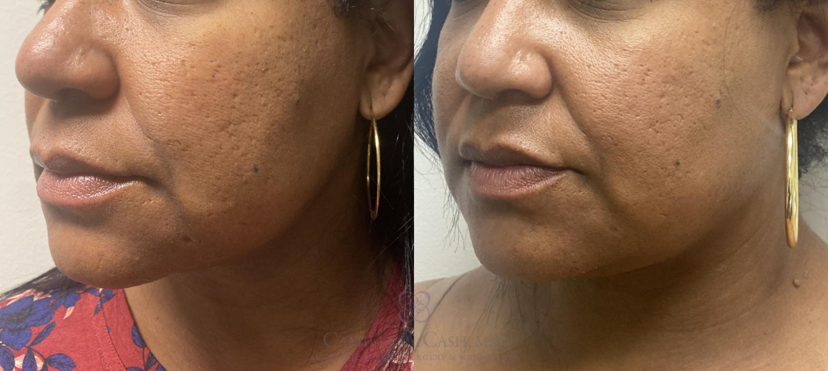 Before & After Evoke by InMode Case 466 Right Oblique View in Houston, TX