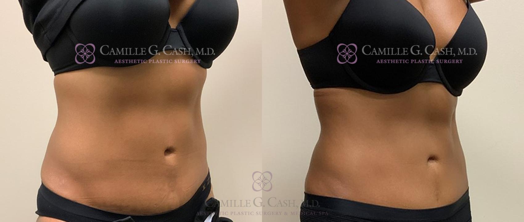 Before & After Evolve by InMode Case 341 View #2 View in Houston, TX