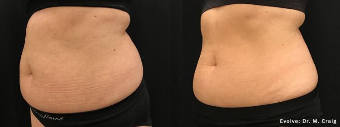 Before & After Evolve by InMode Case 671 Left Oblique View in Houston, TX