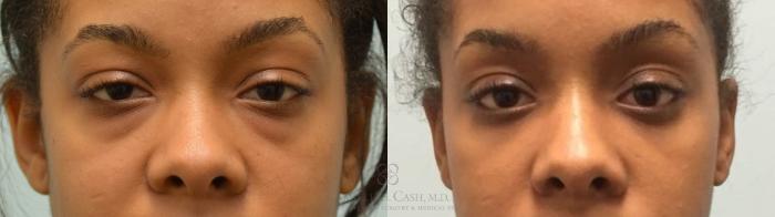 Before & After Eyelid Surgery Case 143 Front View in Houston, TX