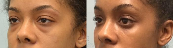 Before & After Eyelid Surgery Case 143 left ob 2 View in Houston, TX