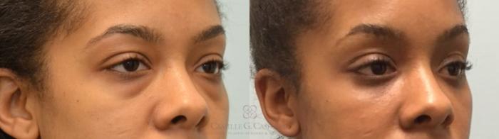 Before & After Eyelid Surgery Case 143 Right Oblique View in Houston, TX