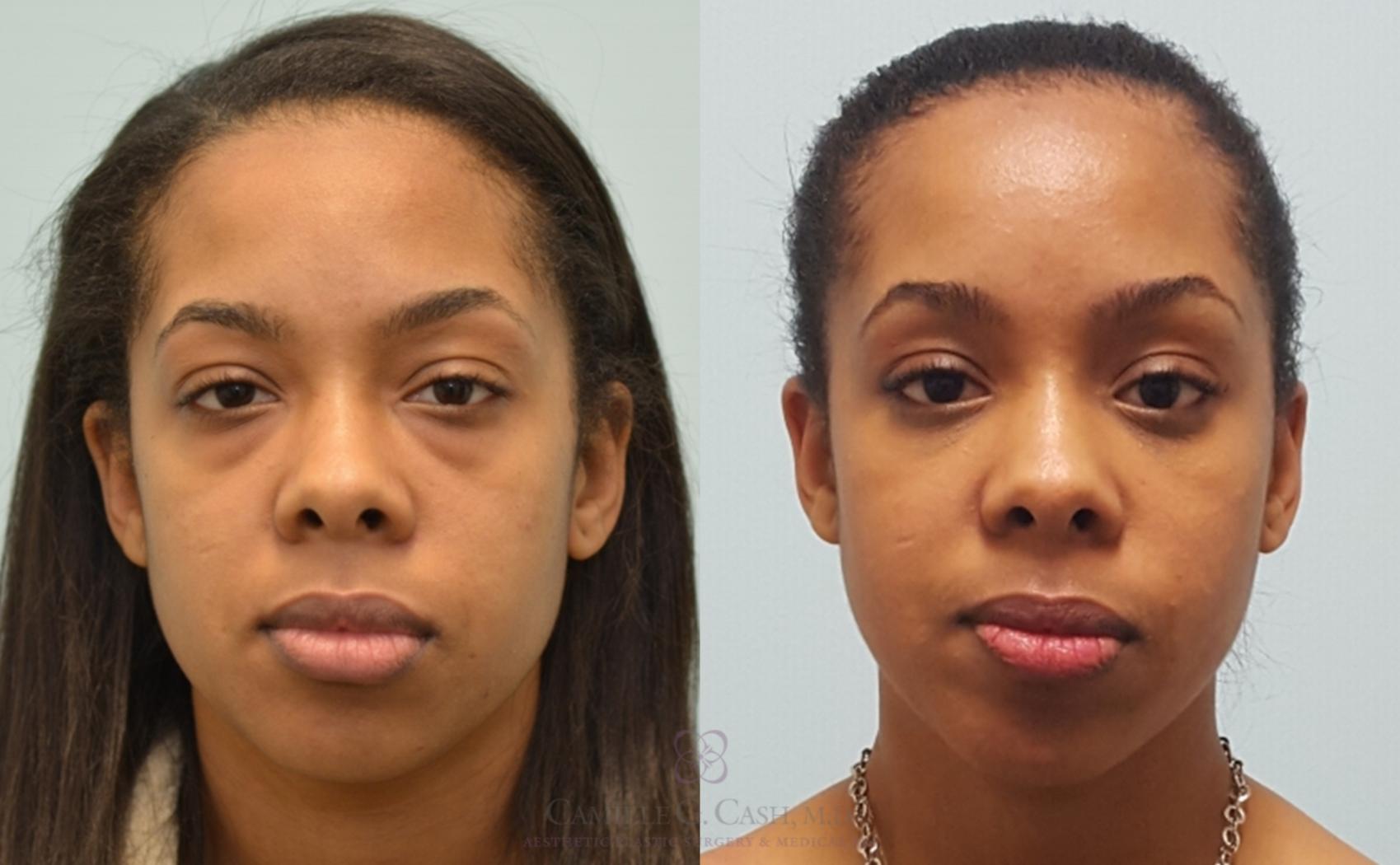 Before & After Eyelid Surgery Case 143 View #2 View in Houston, TX