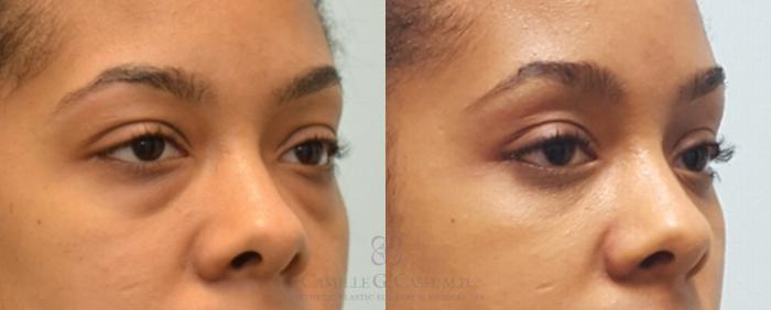 Before & After Eyelid Surgery Case 143 View #3 View in Houston, TX